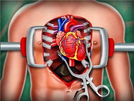 模拟心脏手术 1